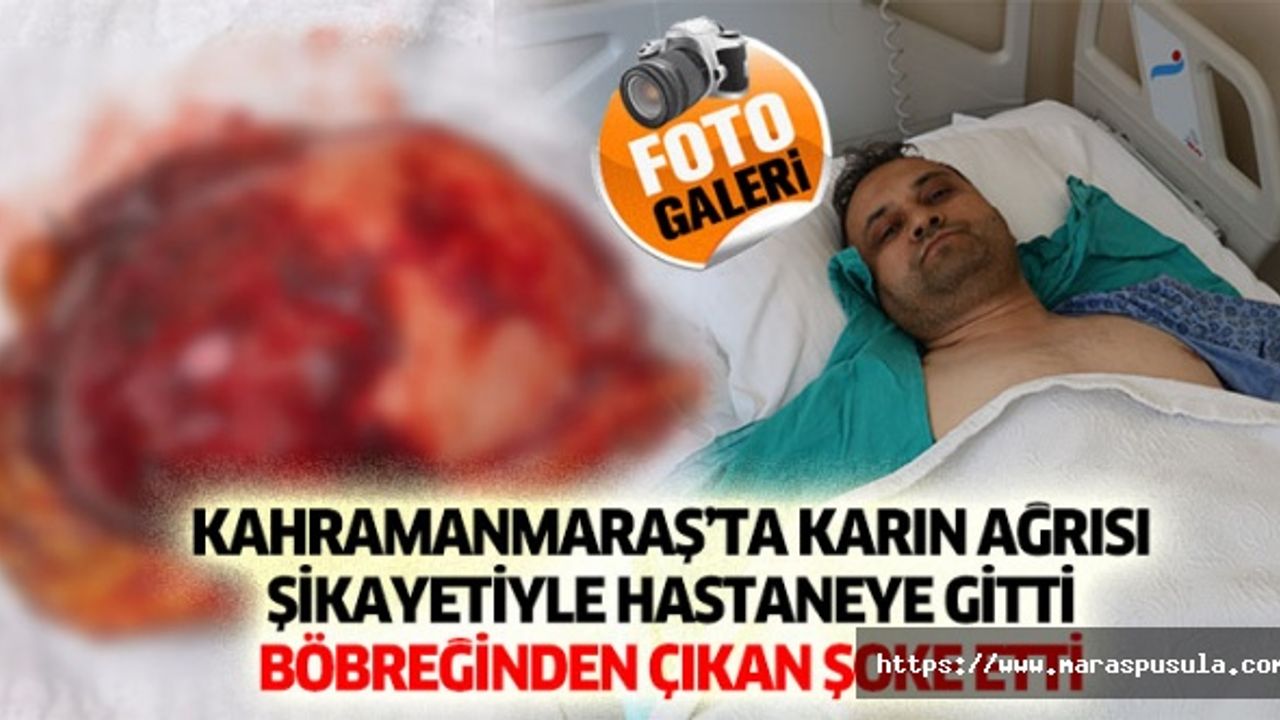 Kahramanmaraş’ta karın ağrısı şikayetiyle hastaneye gitti böbreğinden çıkan şoke etti