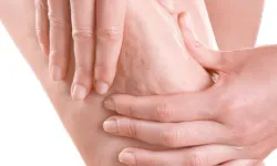 Prof. Dr. Karacalar’dan selülit uyarısı: Portakal kabuğu görüntüsü basit sorun değil!