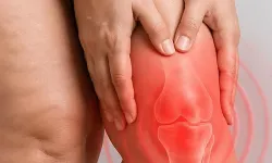 Diz biyomekaniğini bozan süreç: Lipödem