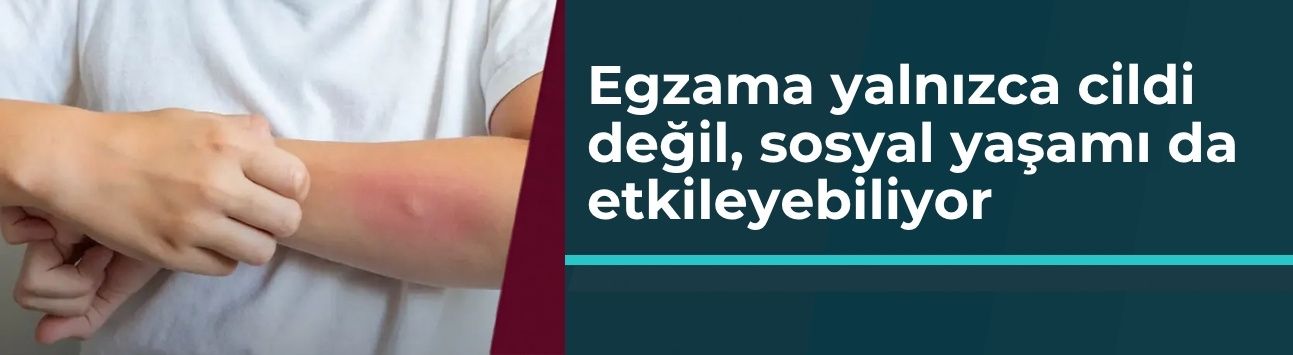 Egzama yalnızca cildi değil, sosyal yaşamı da etkileyebiliyor