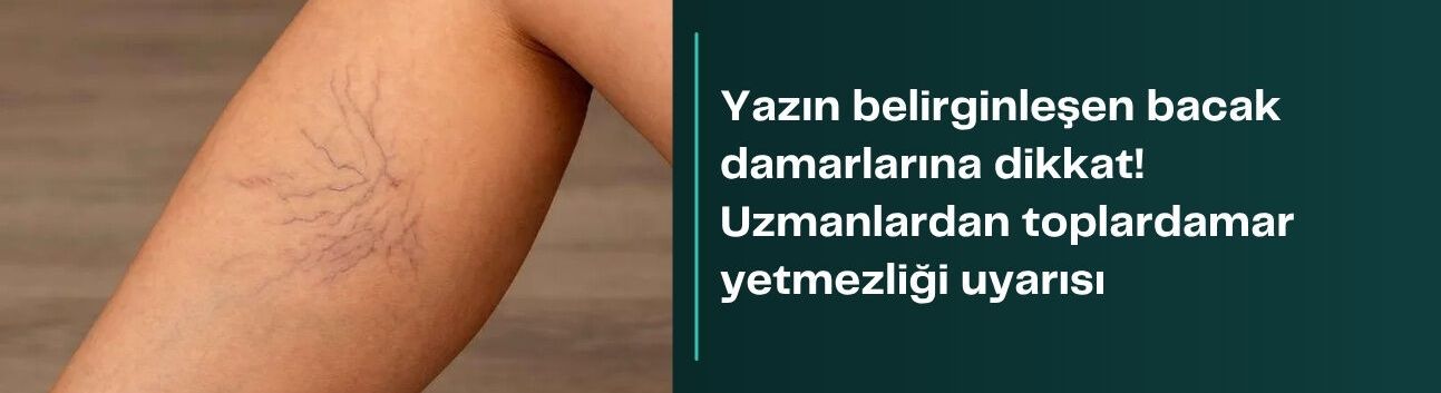 Yazın belirginleşen bacak damarlarına dikkat! Uzmanlardan toplardamar yetmezliği uyarısı